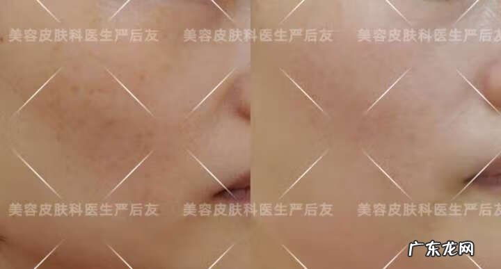 激光祛斑的费用大概多少 色斑的治疗