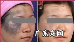 激光祛斑的费用大概多少 色斑的治疗