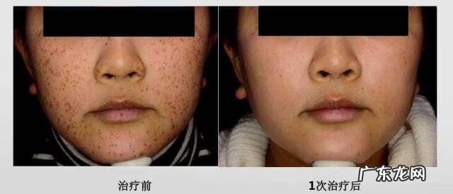激光祛斑的费用大概多少 色斑的治疗