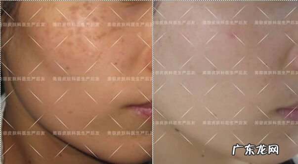 激光祛斑的费用大概多少 色斑的治疗