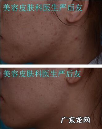 激光祛斑的费用大概多少 色斑的治疗