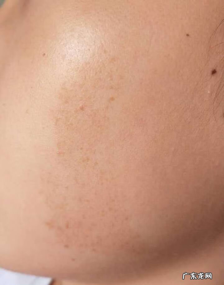 激光祛斑的费用大概多少 色斑的治疗