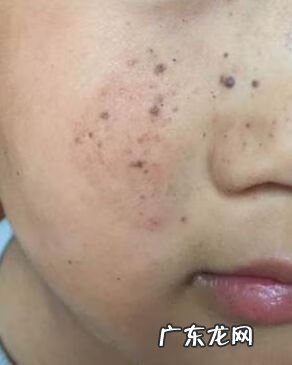 激光祛斑的费用大概多少 色斑的治疗