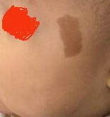 激光祛斑的费用大概多少 色斑的治疗