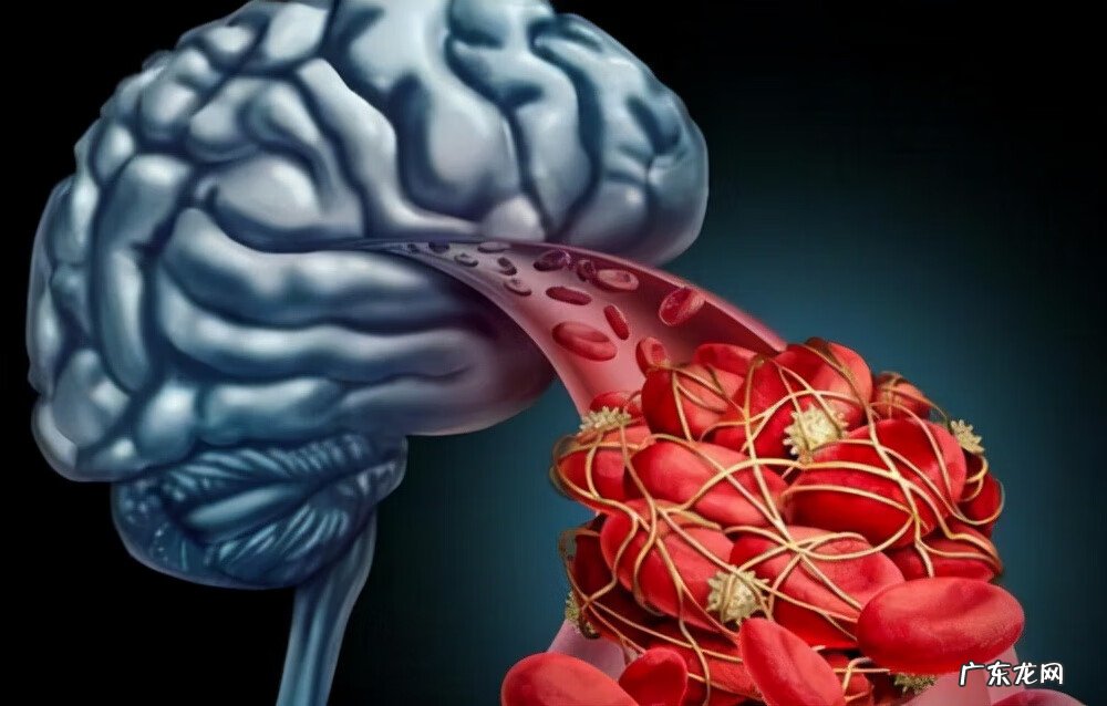 轻微脑梗什么反应 轻微脑梗塞严重吗