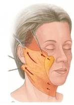 乳房下垂怎么提升上去 胸部松弛下垂怎么办