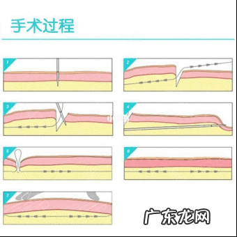 乳房下垂怎么提升上去 胸部松弛下垂怎么办