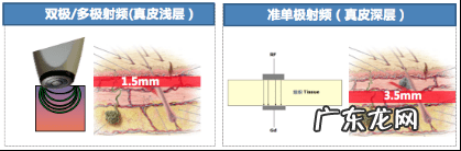 乳房下垂怎么提升上去 胸部松弛下垂怎么办