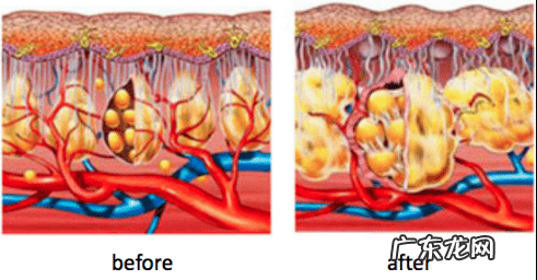 乳房下垂怎么提升上去 胸部松弛下垂怎么办