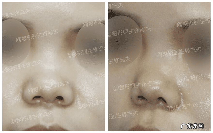 怎样能使鼻子变小 让鼻子变小的方法
