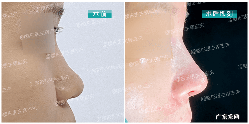 怎样能使鼻子变小 让鼻子变小的方法