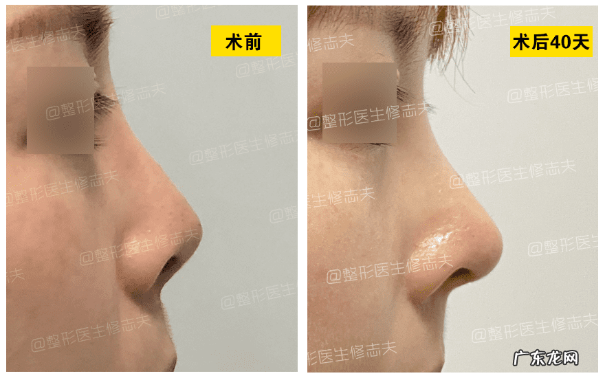 怎样能使鼻子变小 让鼻子变小的方法