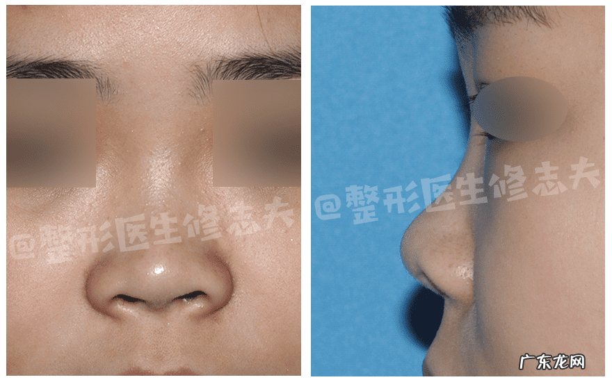 怎样能使鼻子变小 让鼻子变小的方法