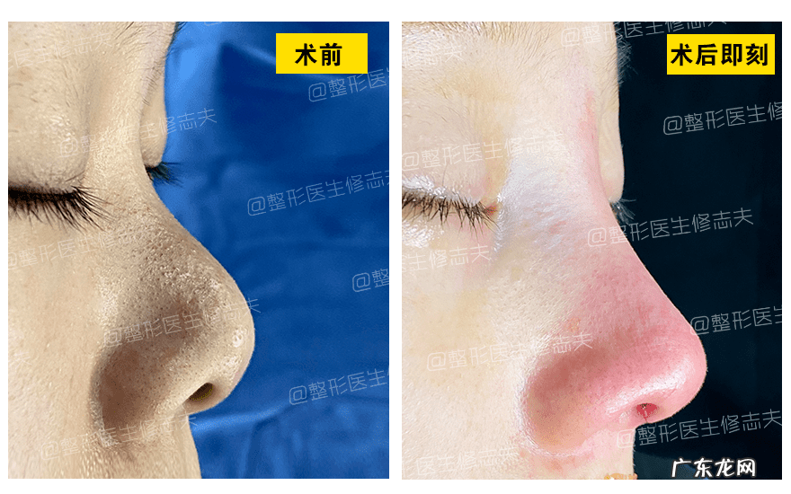 怎样能使鼻子变小 让鼻子变小的方法