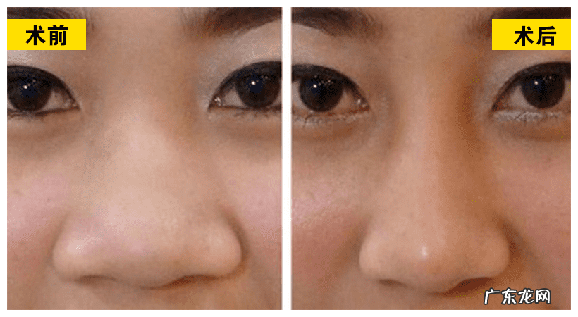 怎样能使鼻子变小 让鼻子变小的方法