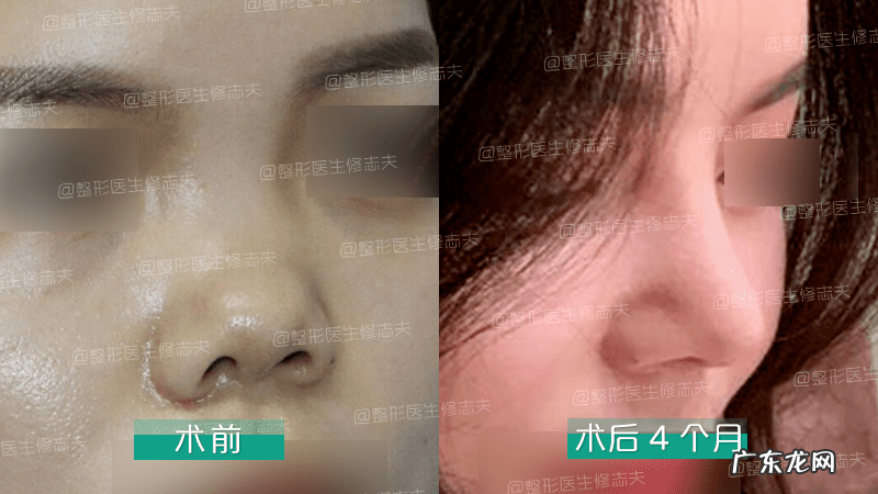 怎样能使鼻子变小 让鼻子变小的方法