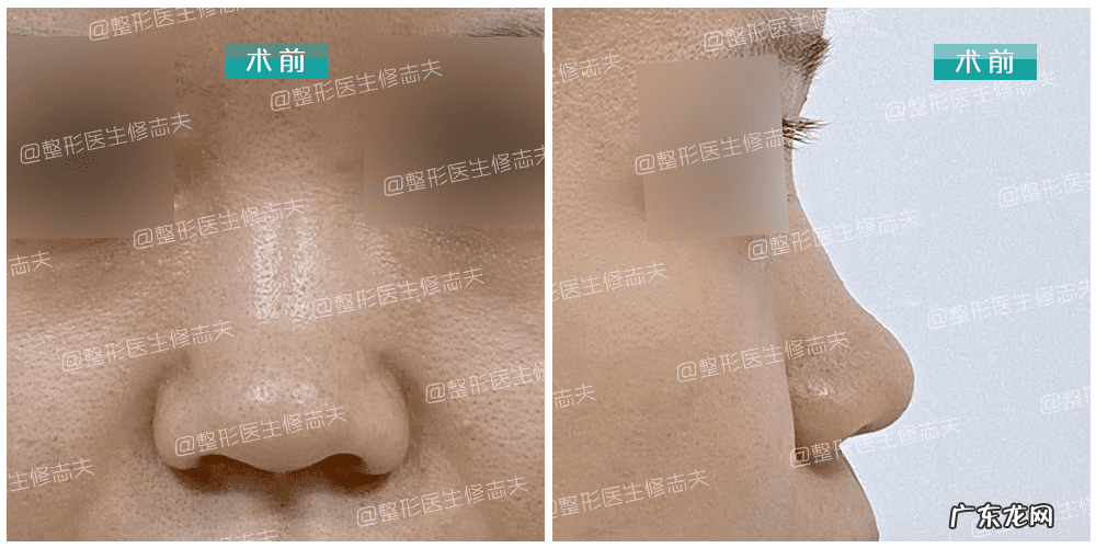 怎样能使鼻子变小 让鼻子变小的方法