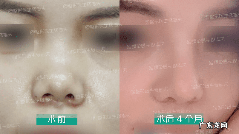 怎样能使鼻子变小 让鼻子变小的方法