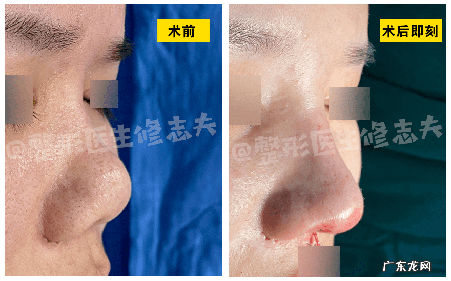 怎样能使鼻子变小 让鼻子变小的方法