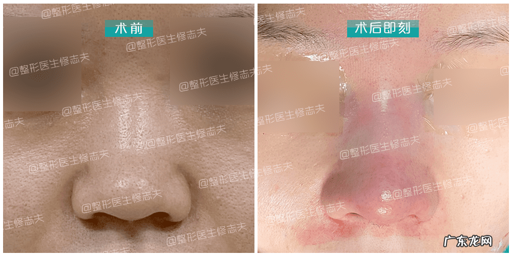 怎样能使鼻子变小 让鼻子变小的方法