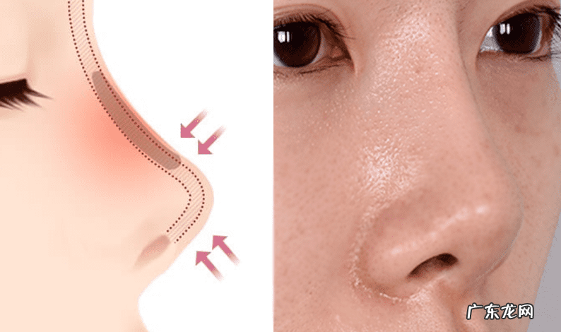 怎样能使鼻子变小 让鼻子变小的方法