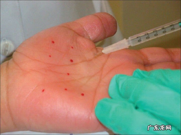 手经常出汗是怎么回事 手心出汗是怎么回事儿