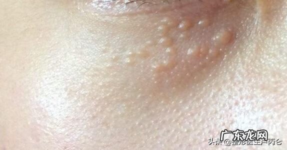 下眼睑边缘上长透明小颗粒 眼睑上长小颗粒叫什么