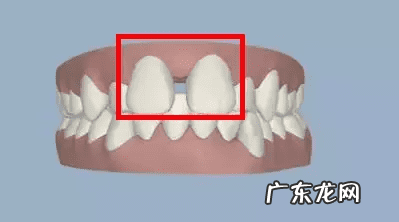 牙缝变大是什么原因造成的 门牙牙缝大怎么办