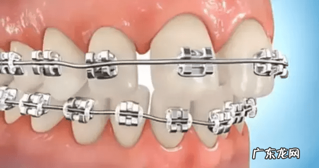 牙缝变大是什么原因造成的 门牙牙缝大怎么办