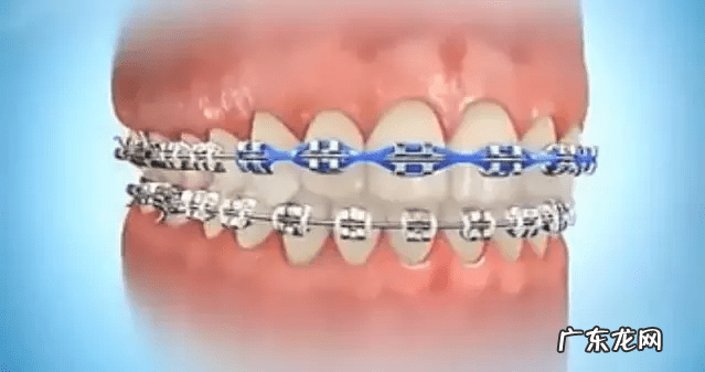 牙缝变大是什么原因造成的 门牙牙缝大怎么办