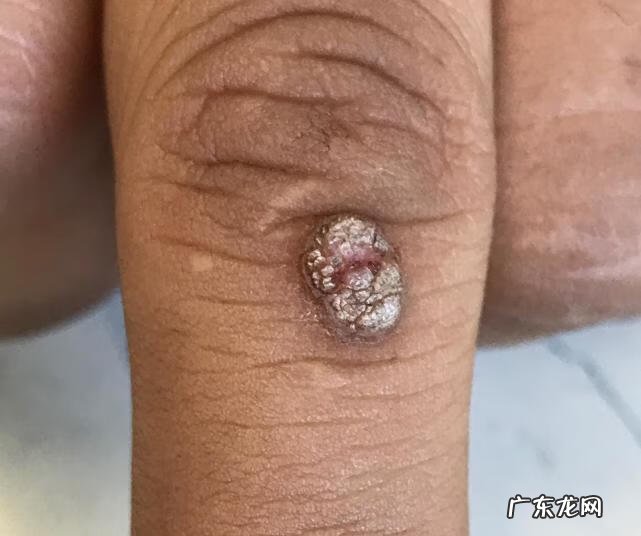 瘊子冷冻后注意事项 瘊子冷冻