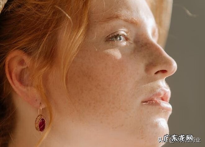 雀斑怎么去除掉 怎样除雀斑