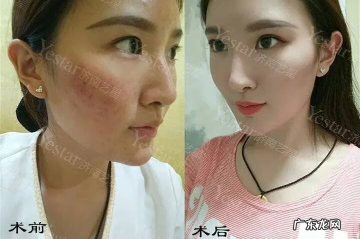 男士激光祛斑多少钱 激光祛斑多少钱呢