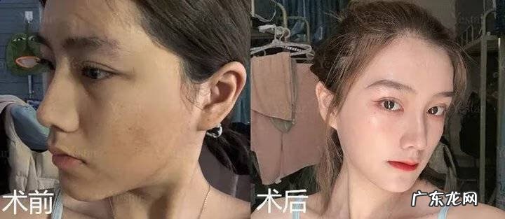 男士激光祛斑多少钱 激光祛斑多少钱呢