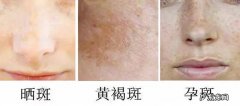 怎么去除脸上的斑 如何去除脸上的斑点