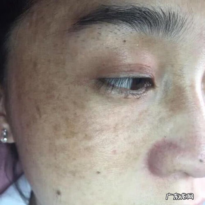 怎么去除脸上的斑 如何去除脸上的斑点