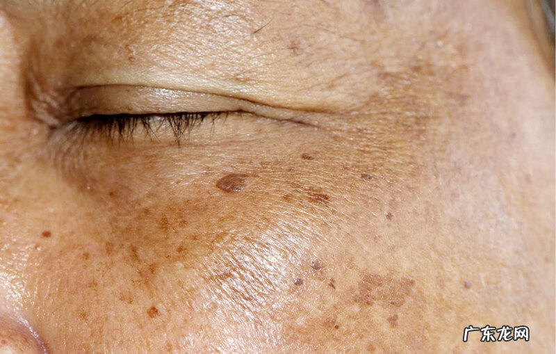 怎么去除脸上的斑 如何去除脸上的斑点
