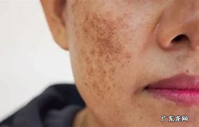 怎么去除脸上的斑 如何去除脸上的斑点
