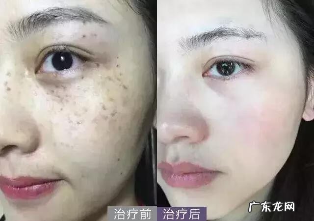 怎么去除脸上的斑 如何去除脸上的斑点
