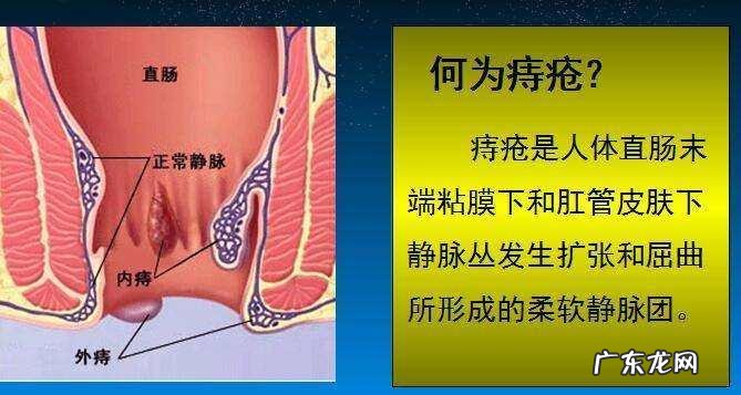 怎么摸知道自己有痔疮 内痔疮最佳的自愈方法