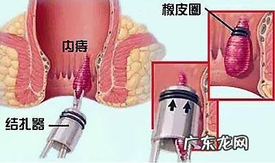 怎么摸知道自己有痔疮 内痔疮最佳的自愈方法