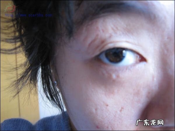 鼻子上有疤痕的人命运 鼻梁有刀疤的风水