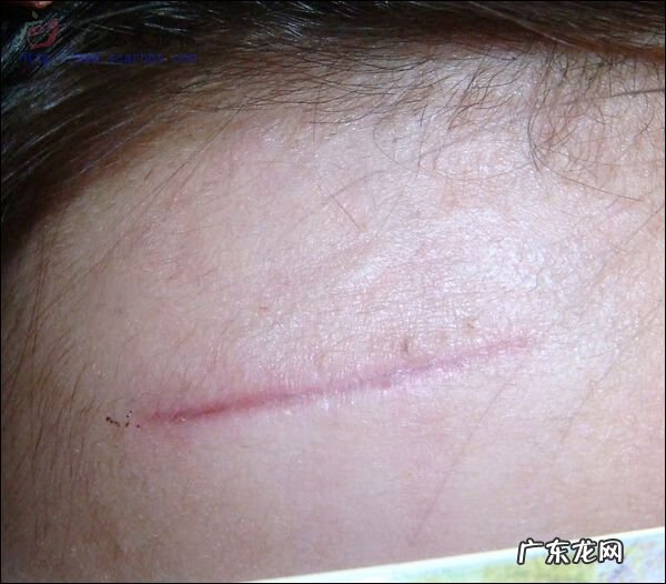 鼻子上有疤痕的人命运 鼻梁有刀疤的风水