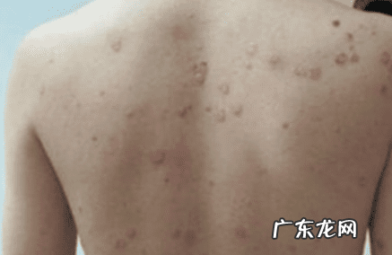 脂溢性皮炎的症状图片 溢脂性皮炎的症状有哪些?