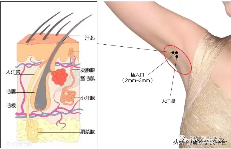 怎么处理腋下臭 腋下臭怎样治疗