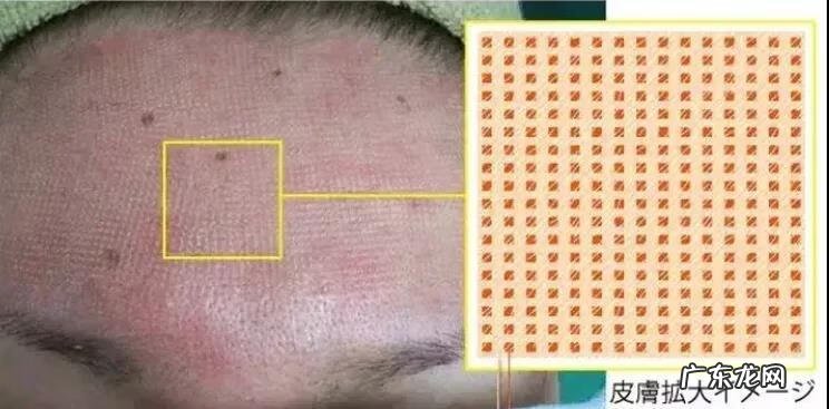 面部有痤疮怎么治 治疗面部痤疮疤痕