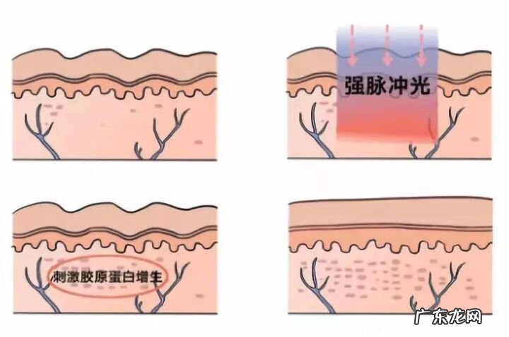 面部有痤疮怎么治 治疗面部痤疮疤痕