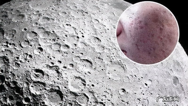 面部有痤疮怎么治 治疗面部痤疮疤痕