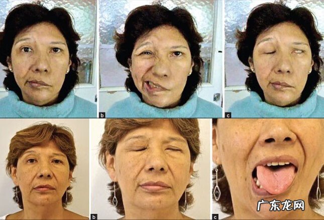 什么原因导致的面瘫 面瘫的病因病理