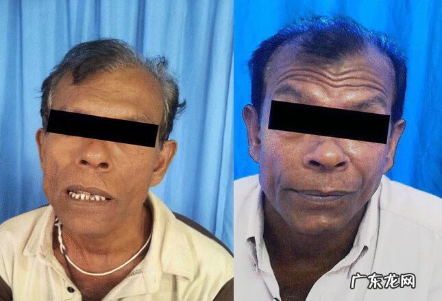 什么原因导致的面瘫 面瘫的病因病理